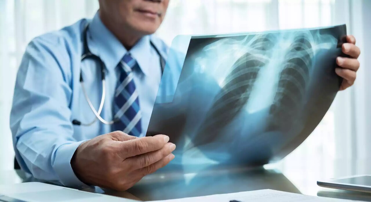 cancer de pulmao estagio 4 tempo de vida