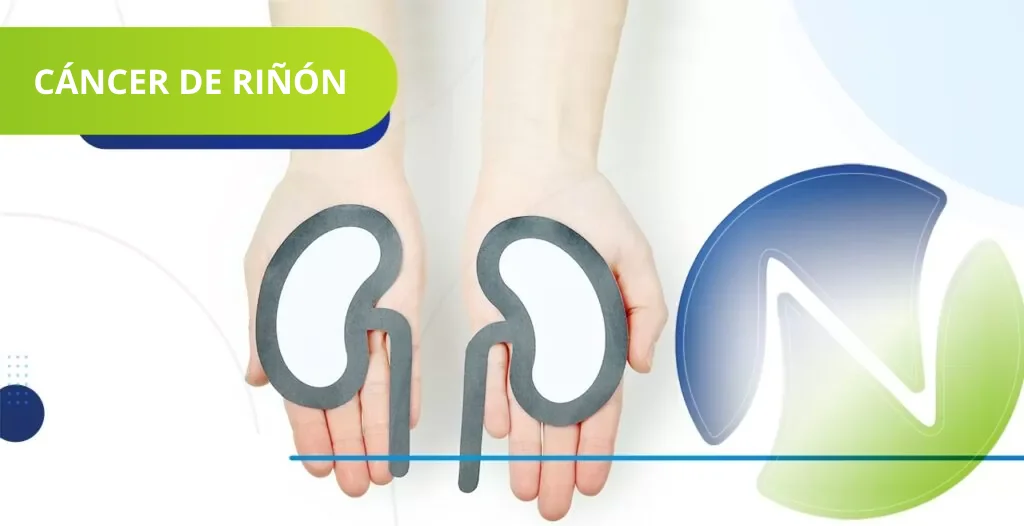 Cáncer de riñón conozca más sobre la enfermedad