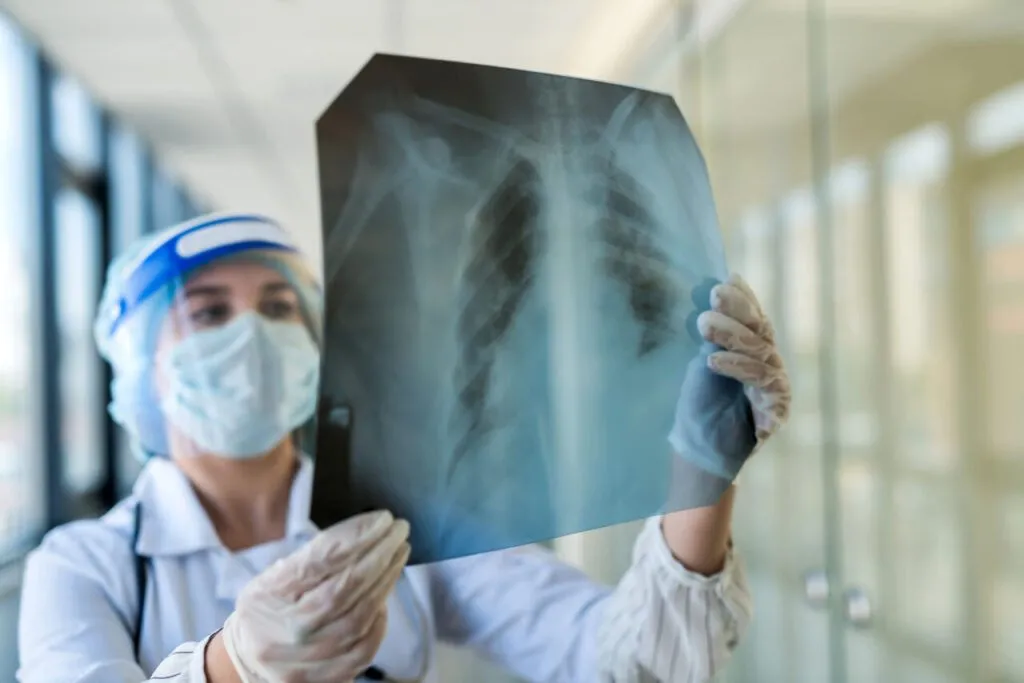 o que &eacute; embolia pulmonar